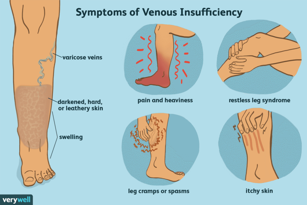 chronic-venuous-insufficiency-overview-1024x683 Donald Trump diagnosed with chronic venous insufficiency. What is this condition?